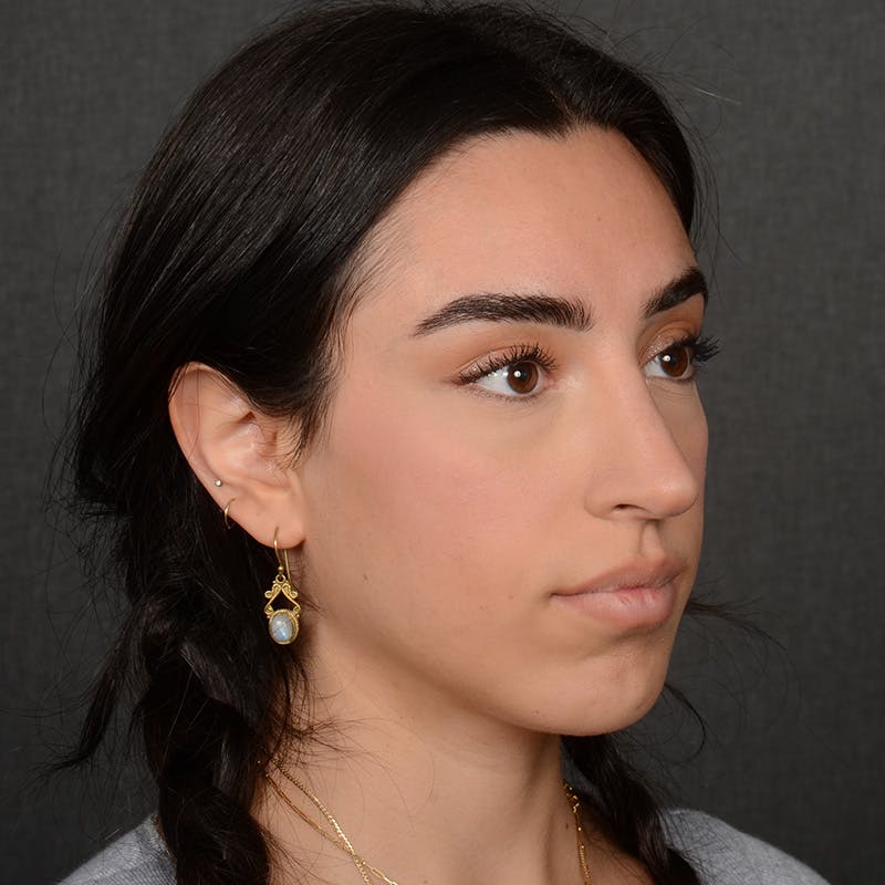 Female Rhinoplasty Before & After Gallery - Patient 238657 - Image 4