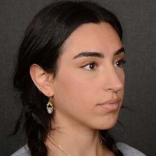 Female Rhinoplasty Before & After Gallery - Patient 238657 - Image 4