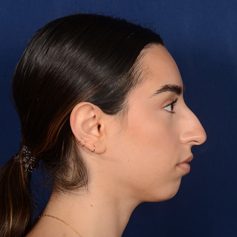 Female Rhinoplasty Before & After Gallery - Patient 238657 - Image 5