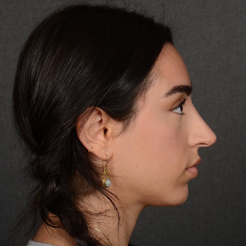 Female Rhinoplasty Before & After Gallery - Patient 238657 - Image 6