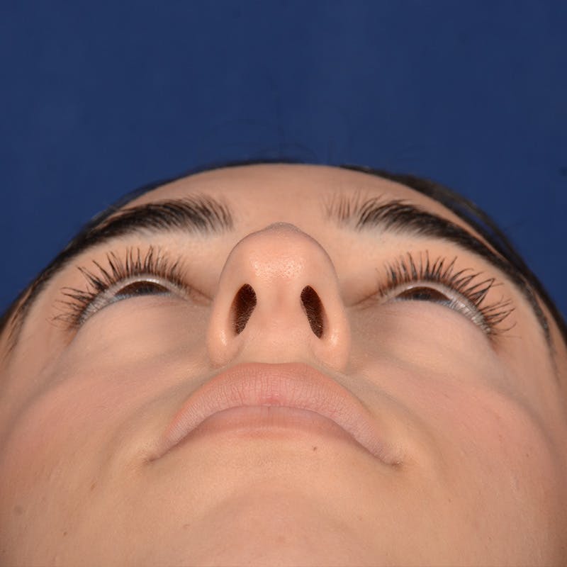 Female Rhinoplasty Before & After Gallery - Patient 238657 - Image 7