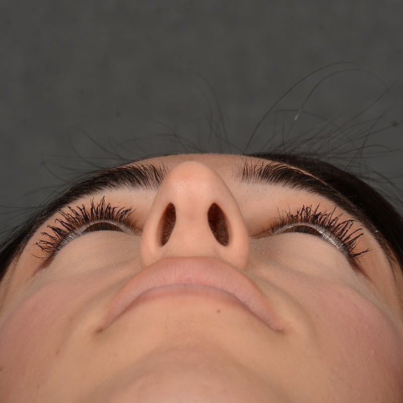 Female Rhinoplasty Before & After Gallery - Patient 238657 - Image 8