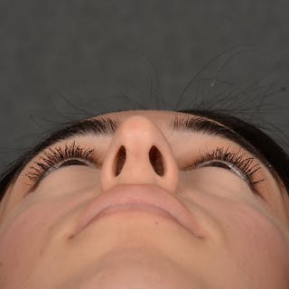 Female Rhinoplasty Before & After Gallery - Patient 238657 - Image 8