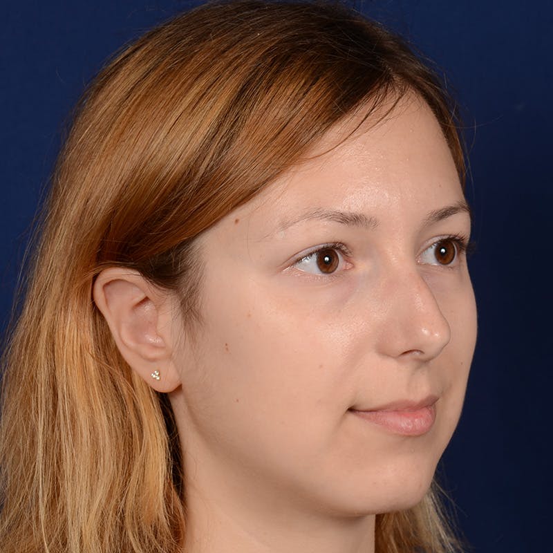 Female Rhinoplasty Before & After Gallery - Patient 262869 - Image 3