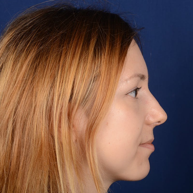 Female Rhinoplasty Before & After Gallery - Patient 262869 - Image 6