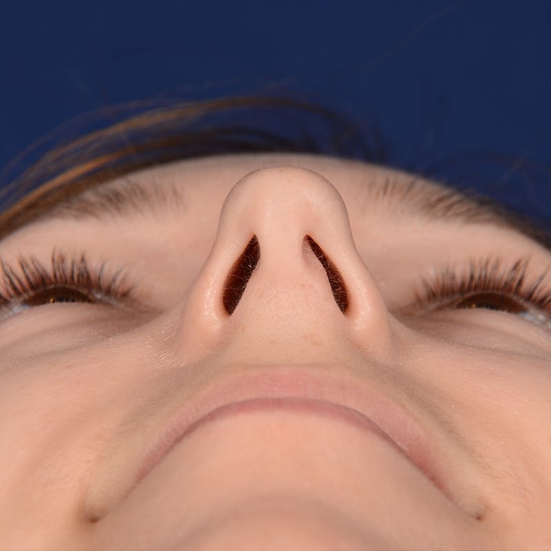 Female Rhinoplasty Before & After Gallery - Patient 262869 - Image 7