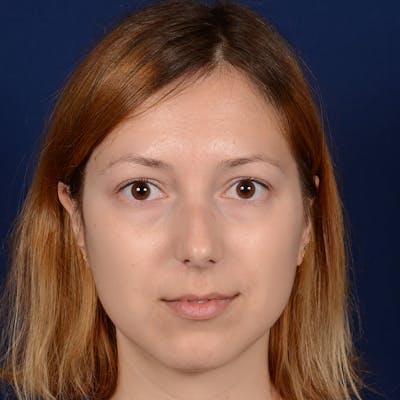 Female Rhinoplasty Before & After Gallery - Patient 262869 - Image 1