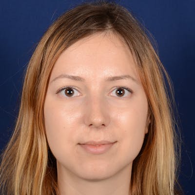 Female Rhinoplasty Before & After Gallery - Patient 262869 - Image 2