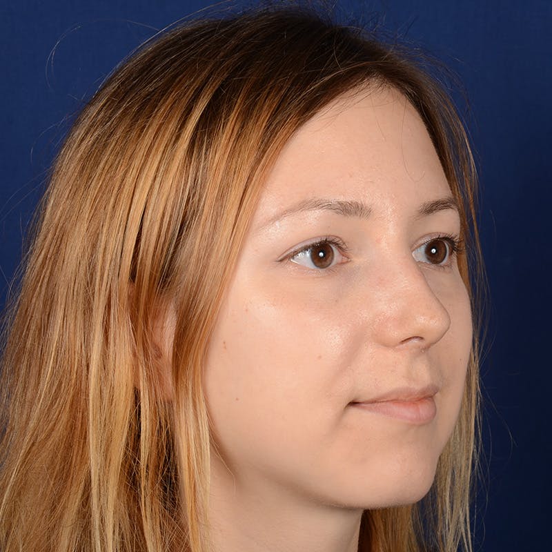 Female Rhinoplasty Before & After Gallery - Patient 262869 - Image 4