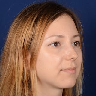 Female Rhinoplasty Before & After Gallery - Patient 262869 - Image 4