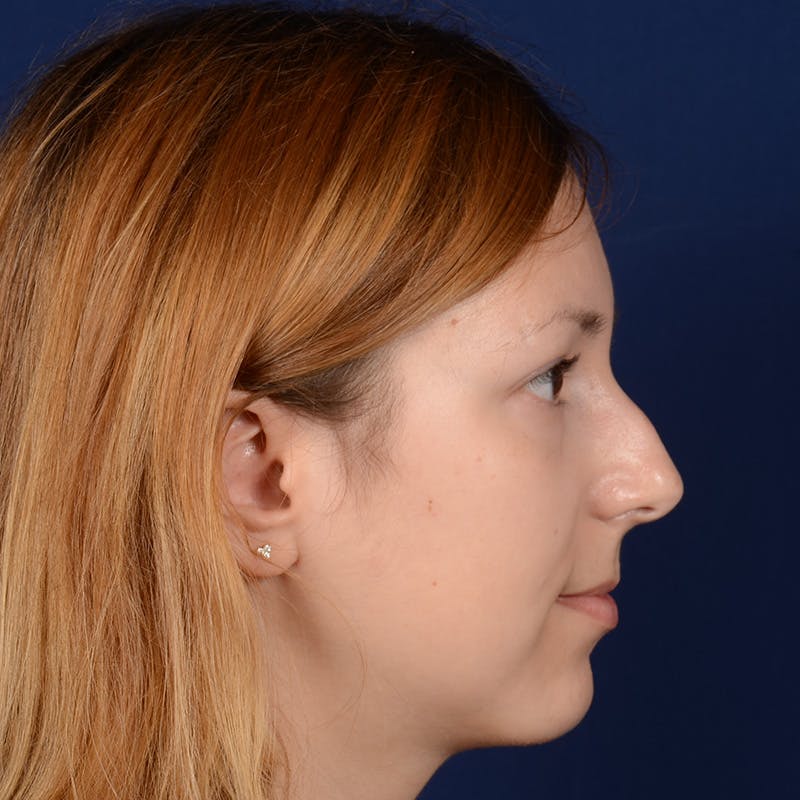 Female Rhinoplasty Before & After Gallery - Patient 262869 - Image 5