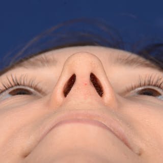 Female Rhinoplasty Before & After Gallery - Patient 262869 - Image 8