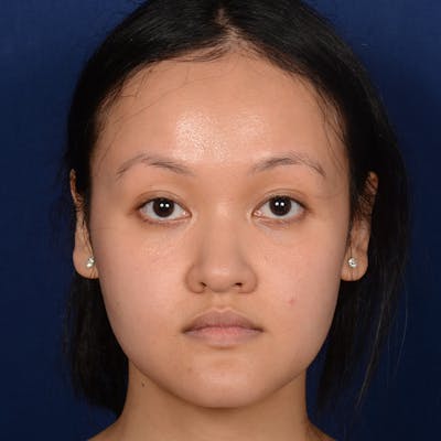 Female Rhinoplasty Before & After Gallery - Patient 177890 - Image 1
