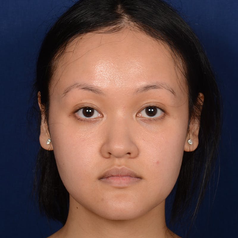 Female Rhinoplasty Before & After Gallery - Patient 177890 - Image 1