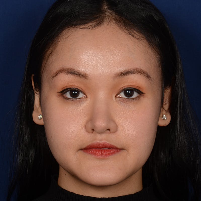 Female Rhinoplasty Before & After Gallery - Patient 177890 - Image 2