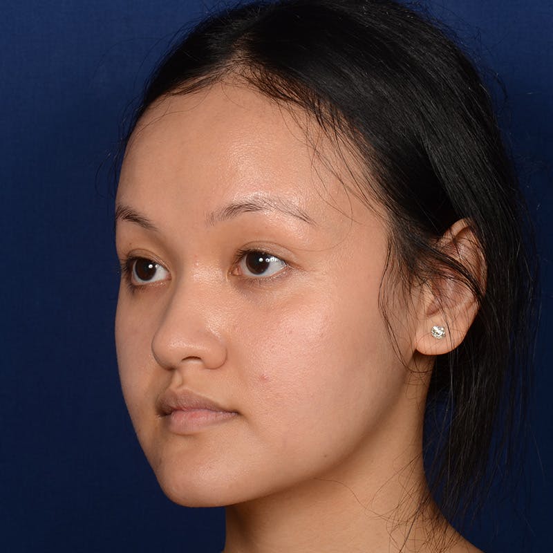 Female Rhinoplasty Before & After Gallery - Patient 177890 - Image 3