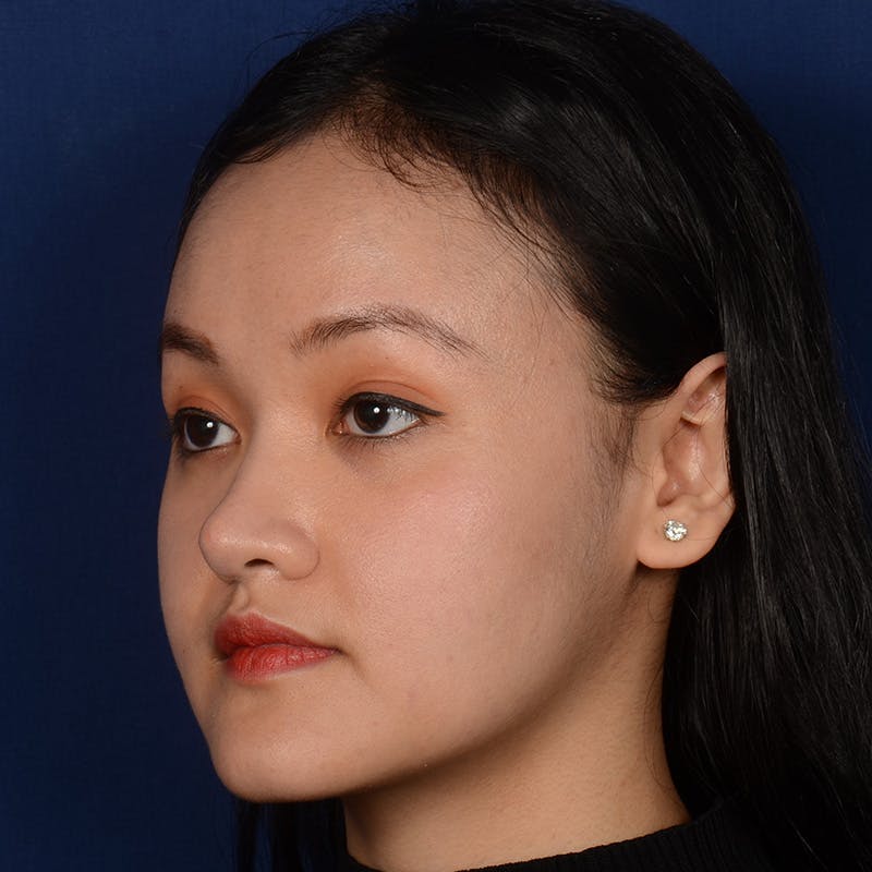 Female Rhinoplasty Before & After Gallery - Patient 177890 - Image 4
