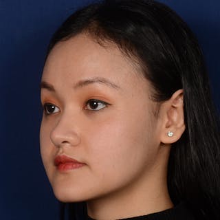 Female Rhinoplasty Before & After Gallery - Patient 177890 - Image 4