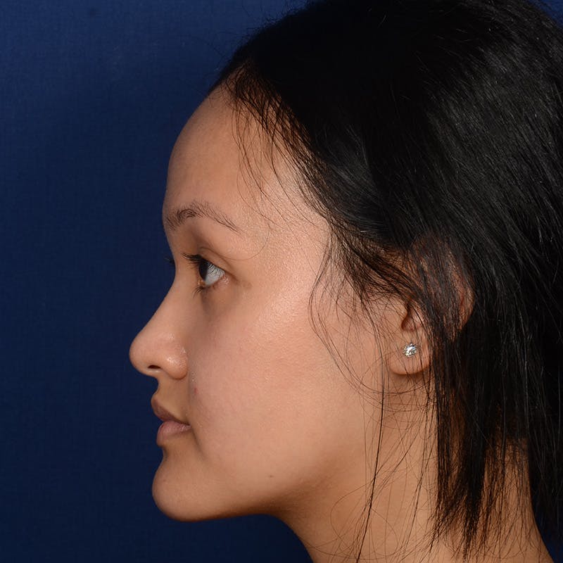 Female Rhinoplasty Before & After Gallery - Patient 177890 - Image 5