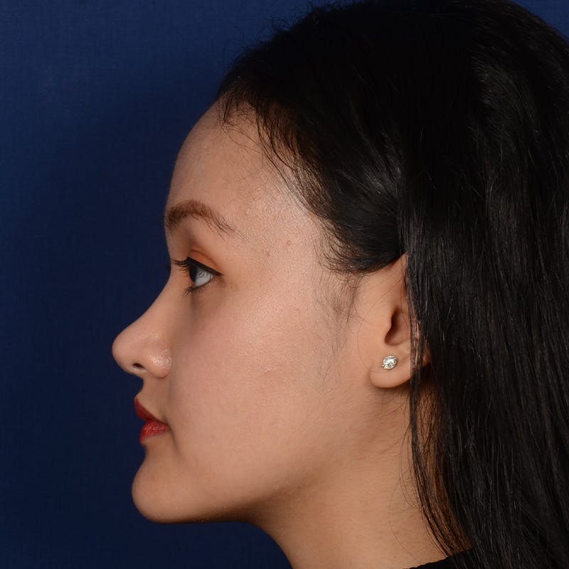 Female Rhinoplasty Before & After Gallery - Patient 177890 - Image 6