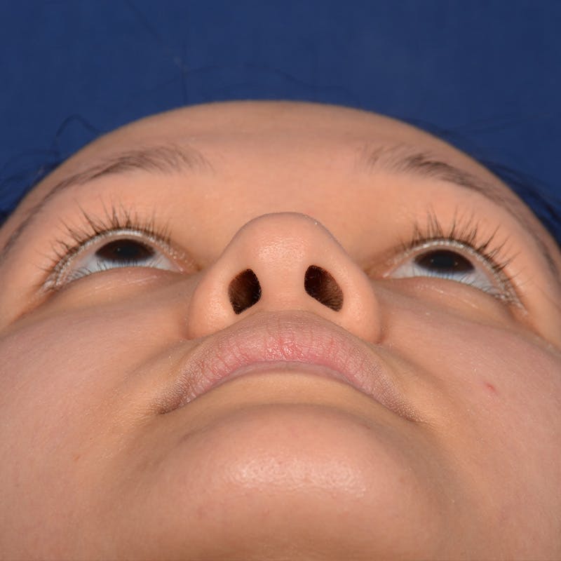 Female Rhinoplasty Before & After Gallery - Patient 177890 - Image 7