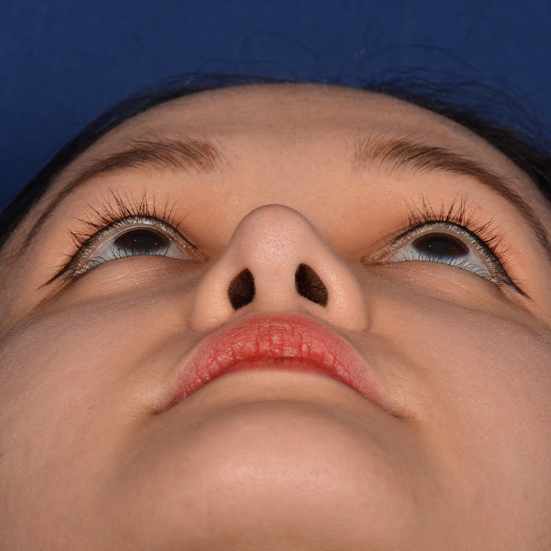 Female Rhinoplasty Before & After Gallery - Patient 177890 - Image 8