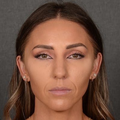 Female Rhinoplasty Before & After Gallery - Patient 414807 - Image 1