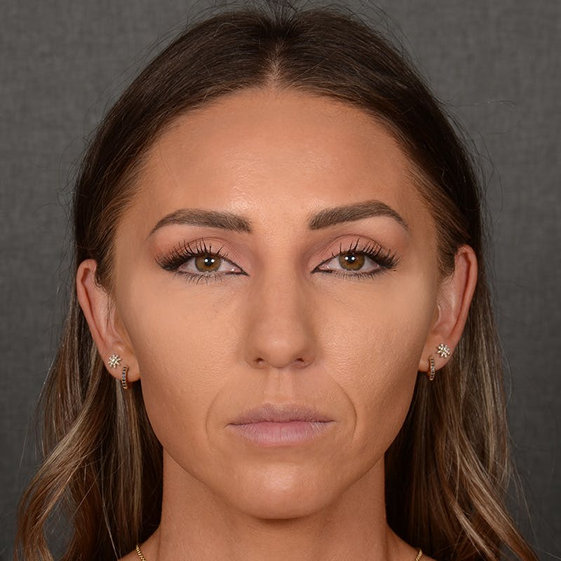 Female Rhinoplasty Before & After Gallery - Patient 414807 - Image 1