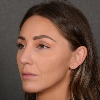 Female Rhinoplasty Before & After Gallery - Patient 414807 - Image 4