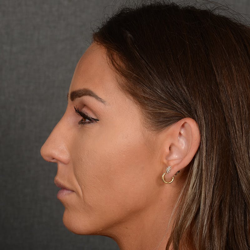 Female Rhinoplasty Before & After Gallery - Patient 414807 - Image 5