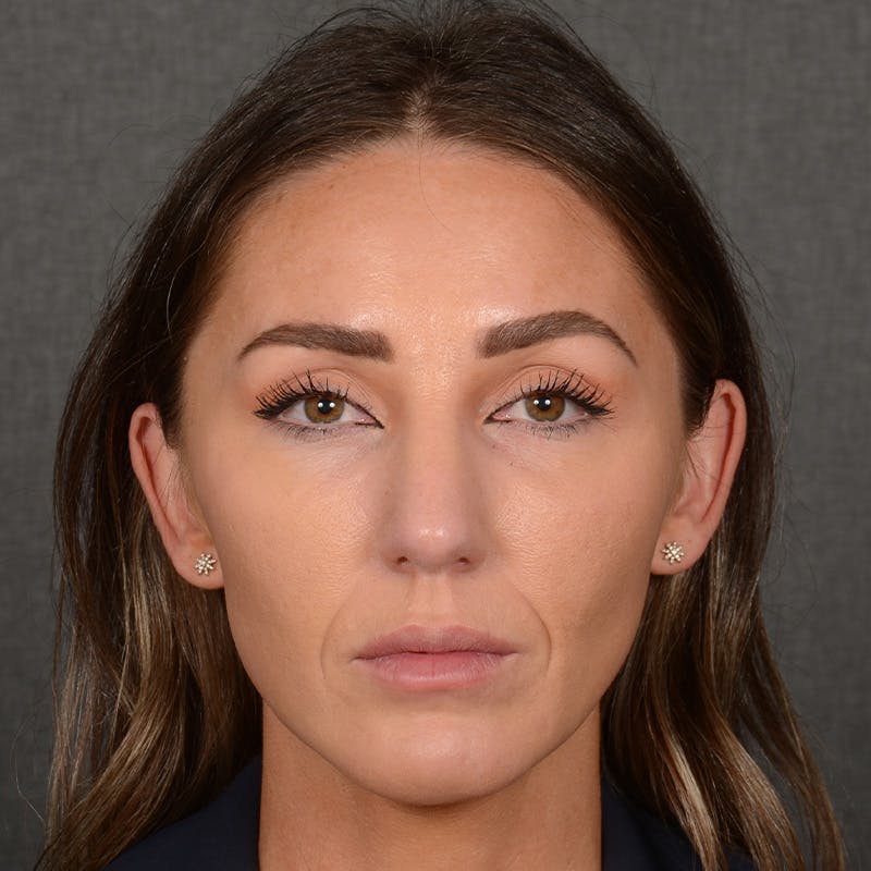 Female Rhinoplasty Before & After Gallery - Patient 414807 - Image 2