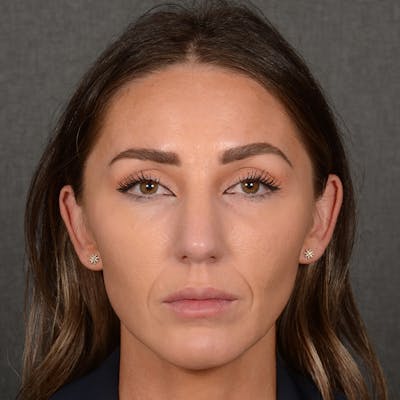 Female Rhinoplasty Before & After Gallery - Patient 414807 - Image 2