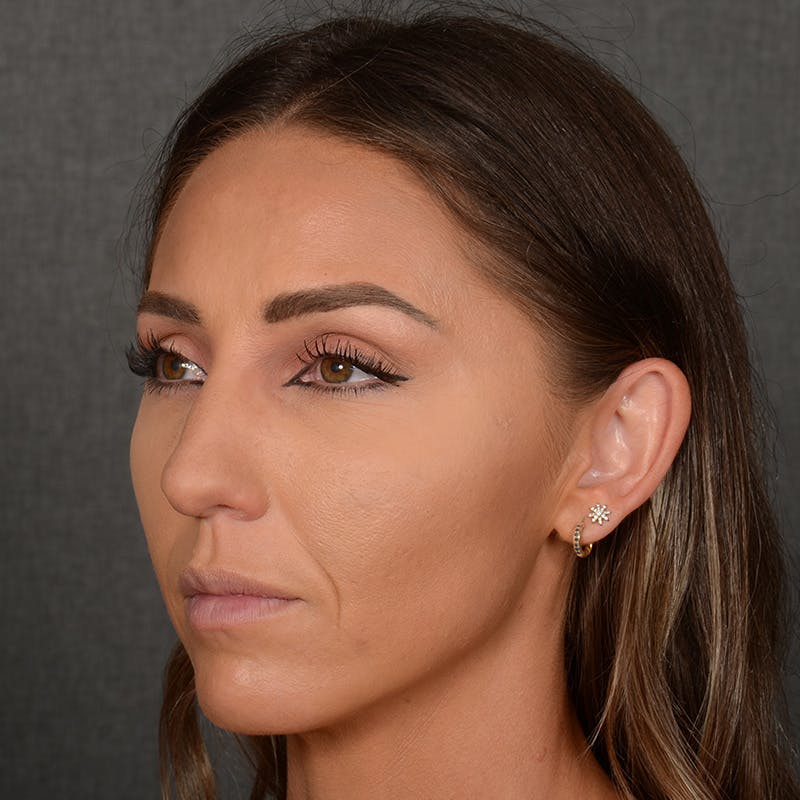 Female Rhinoplasty Before & After Gallery - Patient 414807 - Image 3