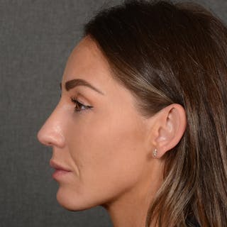 Female Rhinoplasty Before & After Gallery - Patient 414807 - Image 6