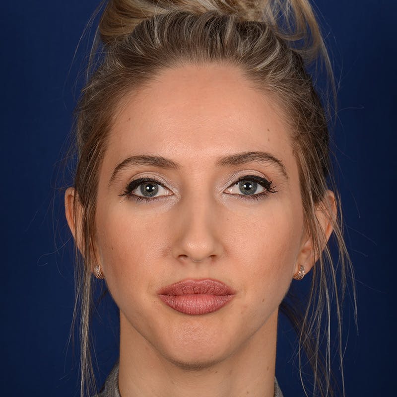 Female Rhinoplasty Before & After Gallery - Patient 195369 - Image 1