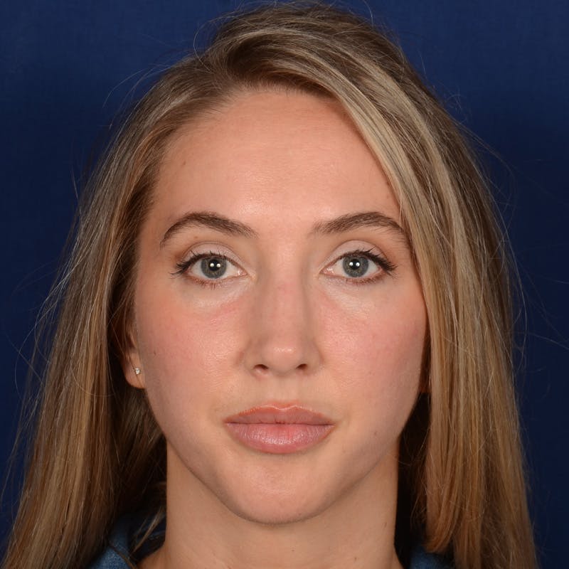 Female Rhinoplasty Before & After Gallery - Patient 195369 - Image 2