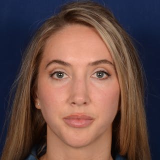 Female Rhinoplasty Before & After Gallery - Patient 195369 - Image 2