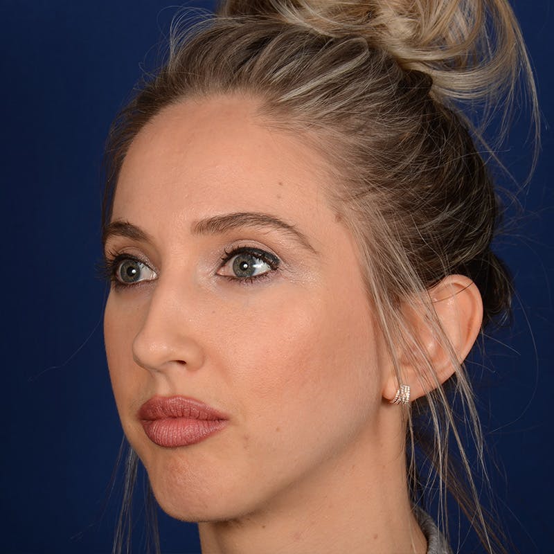 Female Rhinoplasty Before & After Gallery - Patient 195369 - Image 3