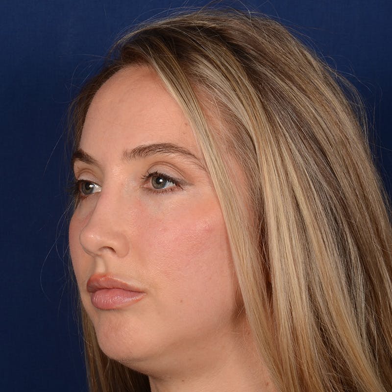 Female Rhinoplasty Before & After Gallery - Patient 195369 - Image 4