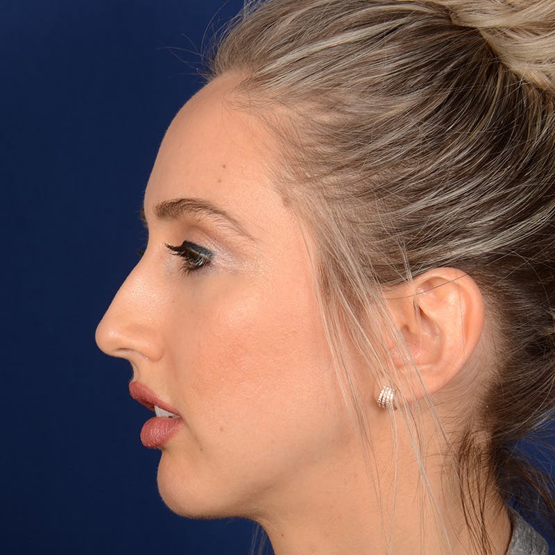 Female Rhinoplasty Before & After Gallery - Patient 195369 - Image 5