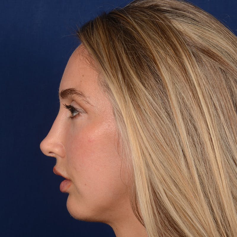 Female Rhinoplasty Before & After Gallery - Patient 195369 - Image 6