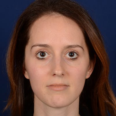Female Rhinoplasty Before & After Gallery - Patient 389365 - Image 1
