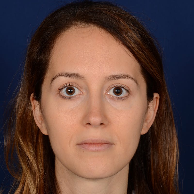 Female Rhinoplasty Before & After Gallery - Patient 389365 - Image 2