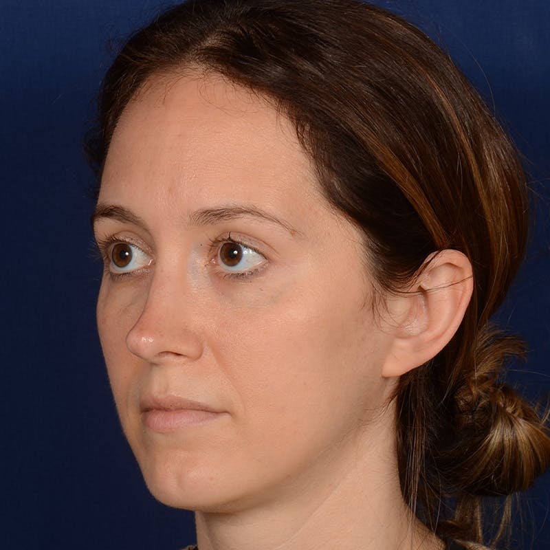 Female Rhinoplasty Before & After Gallery - Patient 389365 - Image 8