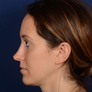 Female Rhinoplasty Before & After Gallery - Patient 389365 - Image 10