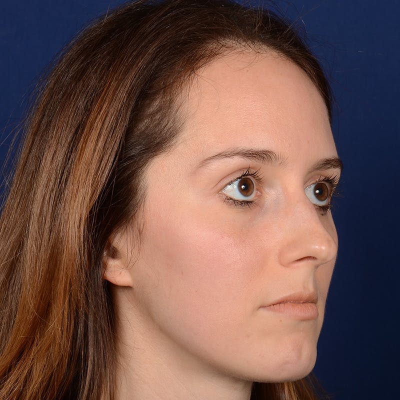 Female Rhinoplasty Before & After Gallery - Patient 389365 - Image 3