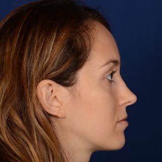 Female Rhinoplasty Before & After Gallery - Patient 389365 - Image 6