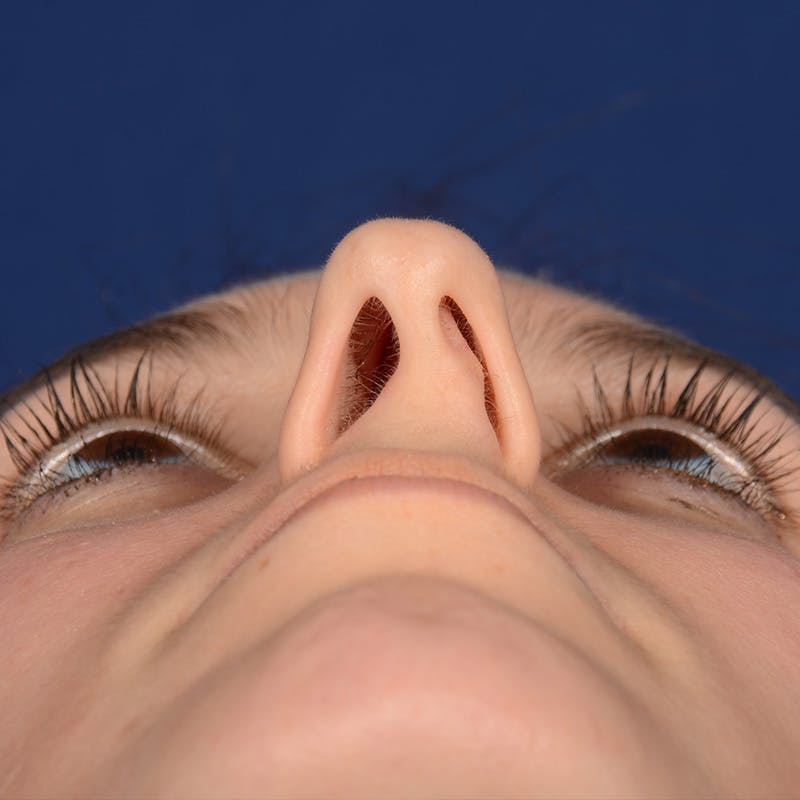 Female Rhinoplasty Before & After Gallery - Patient 389365 - Image 11