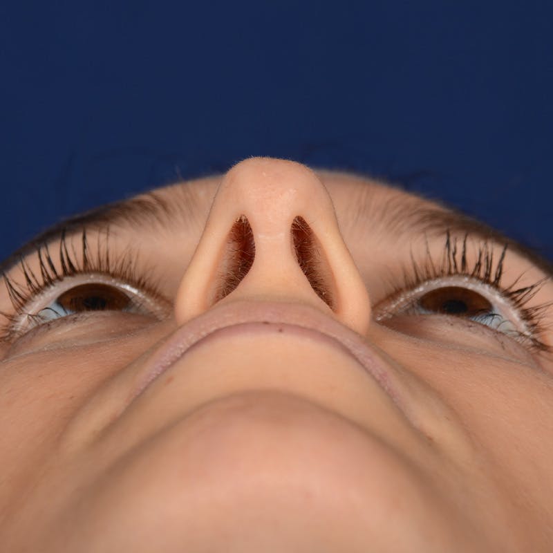 Female Rhinoplasty Before & After Gallery - Patient 389365 - Image 12