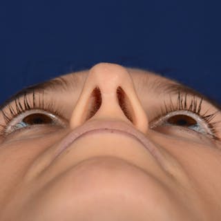 Female Rhinoplasty Before & After Gallery - Patient 389365 - Image 12
